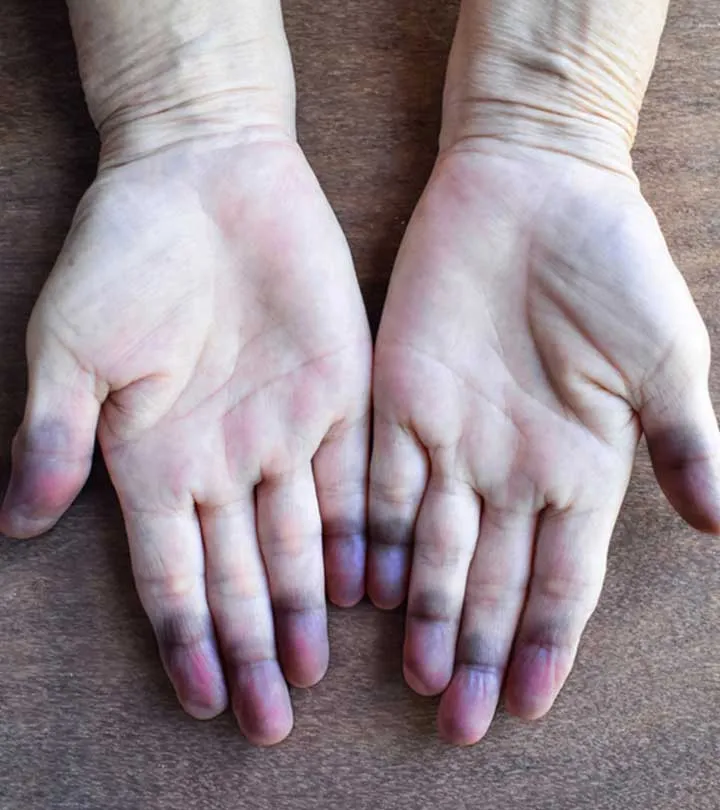 What is Cyanosis Detection?